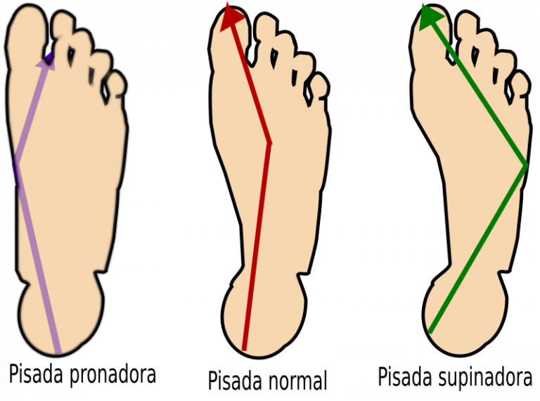 Pisada pronadora, supinadora, normal